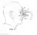 Fig. 06 - Head Frame with Integrated Pressure Chamber for Non-Invasive Intracranial Pressure Measurements