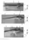 Fig. 11 - Tissue and vascular closure devices and methods of use thereof