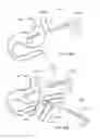 Fig. 19 - Magnetic anastomosis devices and methods of delivery