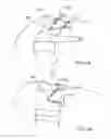 Fig. 22 - Magnetic anastomosis devices and methods of delivery