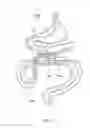 Fig. 25 - Magnetic anastomosis devices and methods of delivery