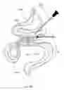 Fig. 26 - Magnetic anastomosis devices and methods of delivery