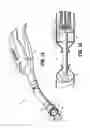 Fig. 02 - Buttress fixation for a circular stapler