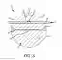 Fig. 04 - EXPANDABLE DEVICE DELIVERY