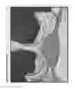 Fig. 03 - Selective spinal tissue removal apparatus and method