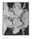 Fig. 04 - Selective spinal tissue removal apparatus and method