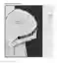 Fig. 05 - Selective spinal tissue removal apparatus and method