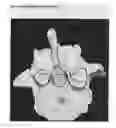Fig. 06 - Selective spinal tissue removal apparatus and method