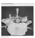 Fig. 07 - Selective spinal tissue removal apparatus and method