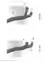 Fig. 27 - Selective spinal tissue removal apparatus and method
