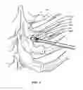 Fig. 04 - SYSTEM AND METHOD FOR CORRECTION OF A SPINAL DISORDER