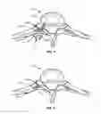 Fig. 05 - SYSTEM AND METHOD FOR CORRECTION OF A SPINAL DISORDER