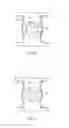 Fig. 22 - Spinous process fusion devices