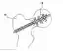Fig. 01 - Medical implant