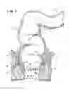Fig. 02 - METHOD FOR TREATING FECAL INCONTINENCE
