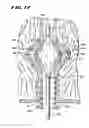 Fig. 16 - METHOD FOR TREATING FECAL INCONTINENCE