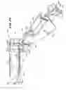 Fig. 19 - METHOD FOR TREATING FECAL INCONTINENCE