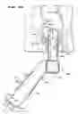 Fig. 23 - METHOD FOR TREATING FECAL INCONTINENCE