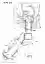 Fig. 24 - METHOD FOR TREATING FECAL INCONTINENCE
