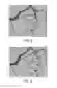 Fig. 07 - Method and system for automated therapy planning for arterial stenosis