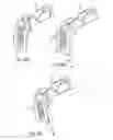 Fig. 06 - Illuminated and modular soft tissue retractor