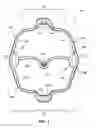 Fig. 02 - Cheek retractor device and method