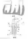 Fig. 07 - A DENTAL IMPLANT