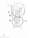 Fig. 08 - Prosthesis