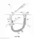 Fig. 70 - Systems, methods and devices relating to delivery of medical implants