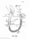 Fig. 71 - Systems, methods and devices relating to delivery of medical implants