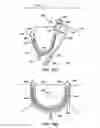 Fig. 75 - Systems, methods and devices relating to delivery of medical implants