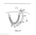 Fig. 76 - Systems, methods and devices relating to delivery of medical implants