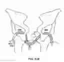 Fig. 84 - Systems, methods and devices relating to delivery of medical implants