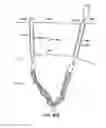 Fig. 91 - Systems, methods and devices relating to delivery of medical implants