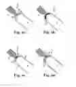 Fig. 04 - Implants, tools, and methods for treating pelvic conditions