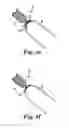 Fig. 05 - Implants, tools, and methods for treating pelvic conditions