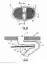 Fig. 09 - Implant for parastomal hernia