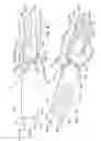 Fig. 07 - Endoluminal prosthesis having multiple branches or fenestrations and methods of deployment