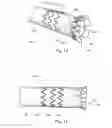 Fig. 09 - Low profile non-symmetrical stent