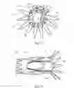 Fig. 11 - Low profile non-symmetrical stent