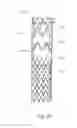 Fig. 12 - Low profile non-symmetrical stent