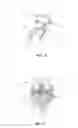 Fig. 04 - Apparatus and method for ligament reconstruction