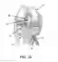Fig. 07 - Apparatus and method for ligament reconstruction