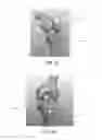 Fig. 20 - Apparatus and method for ligament reconstruction