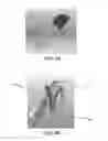 Fig. 24 - Apparatus and method for ligament reconstruction