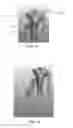 Fig. 25 - Apparatus and method for ligament reconstruction