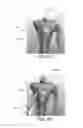 Fig. 26 - Apparatus and method for ligament reconstruction