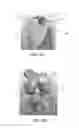Fig. 27 - Apparatus and method for ligament reconstruction