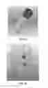 Fig. 31 - Apparatus and method for ligament reconstruction