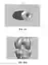 Fig. 45 - Apparatus and method for ligament reconstruction